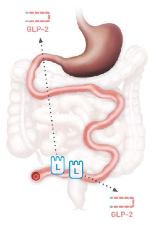 Illustration showing the GLP-2 pathway in a type 1 end jejunostomy with no colon-in-continuity. The image highlights the digestive system, including GLP-2 movement through the small intestine.